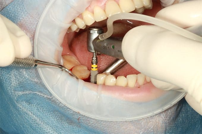 Dental Implants cost
