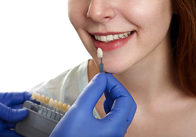 Everything You Need to Know About Veneers and Their Durability